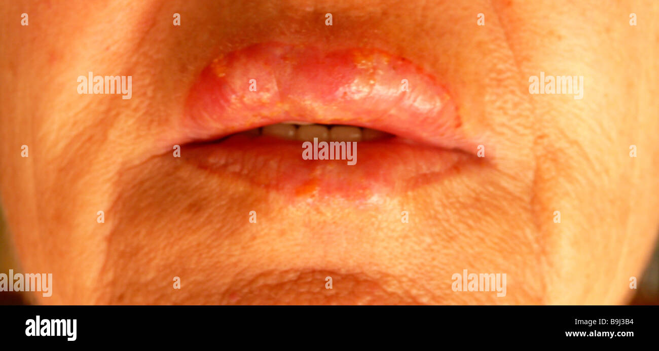 Lèvres visage femme femmes herpès labial-face mouth lip-herpès virus maladie infection virale infection infection de virus Banque D'Images Lèvres visage femme femmes herpès labial-face mouth lip-herpès virus maladie infection virale infection infection de virus Banque D'Images
