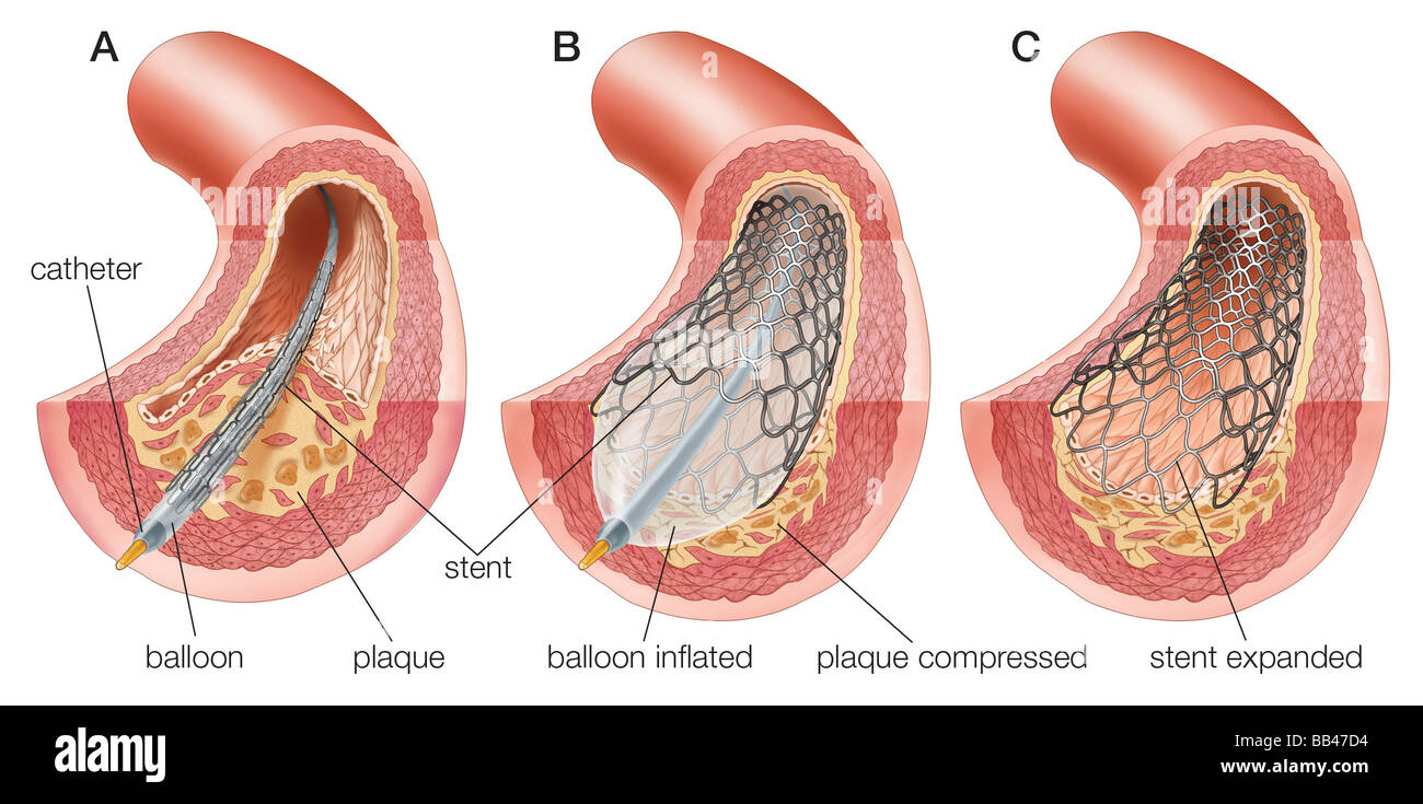 L'angioplastie par ballonnet et insertion de l'endoprothèse Banque D'Images