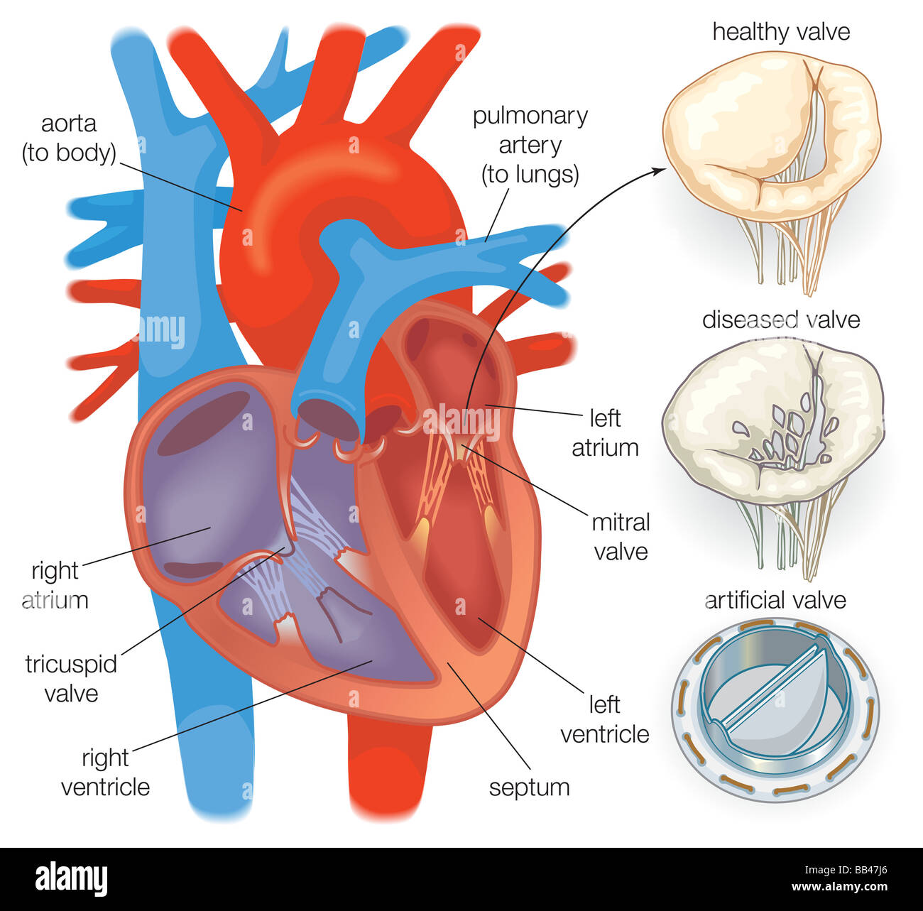 Schéma présentant un cœur en bonne santé par rapport à une vanne valve  cardiaque malade et d'une valve cardiaque artificielle Photo Stock - Alamy