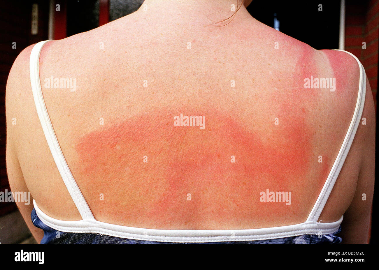 Jeune femme avec un coup de soleil à l'arrière et les épaules Banque D'Images