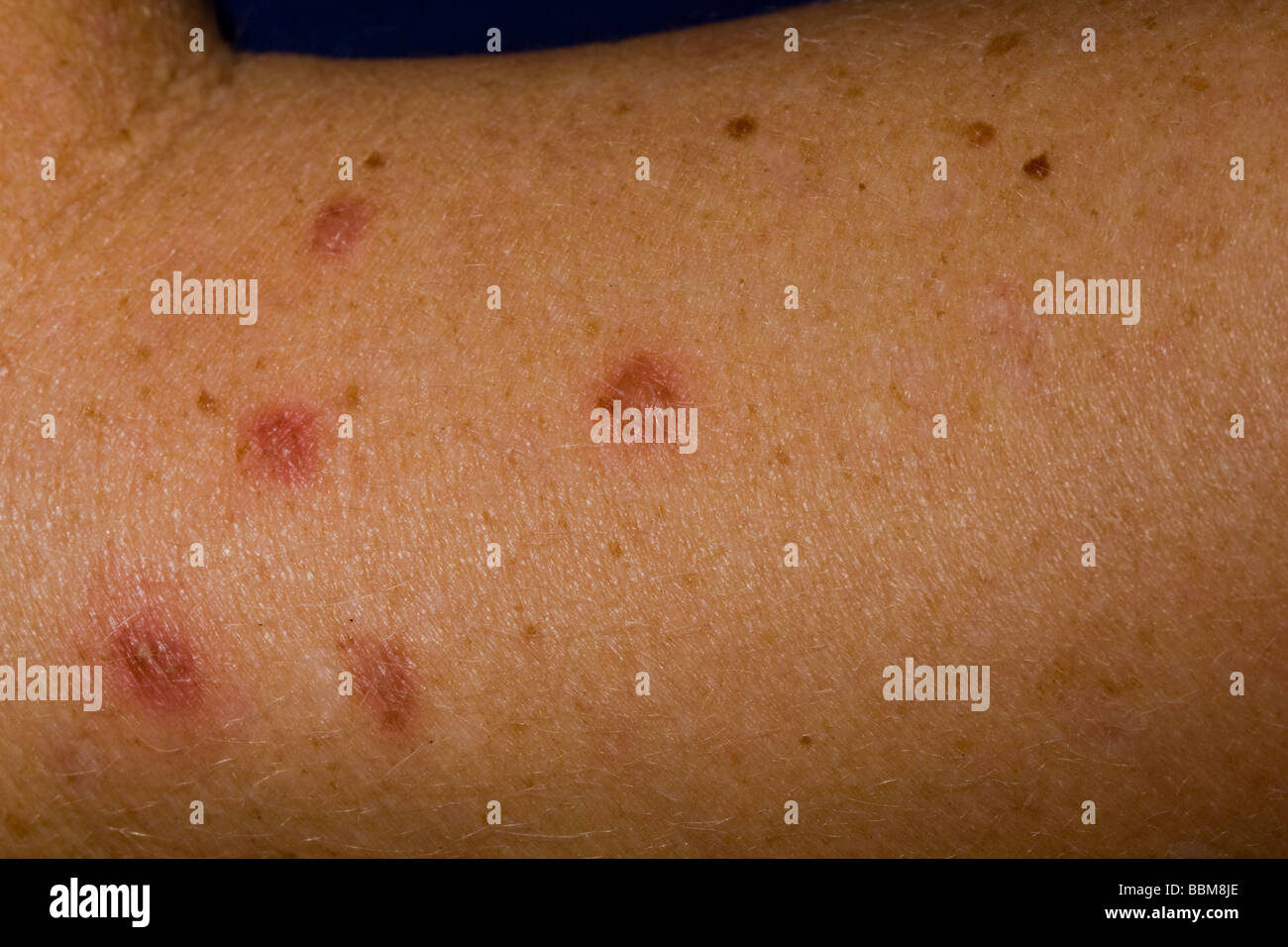 Traitement du cancer de la peau pour les kératoses actiniques solaires/sont pré- lésions cancéreuses et peuvent être traités par la congélation à l'azote liquide Banque D'Images