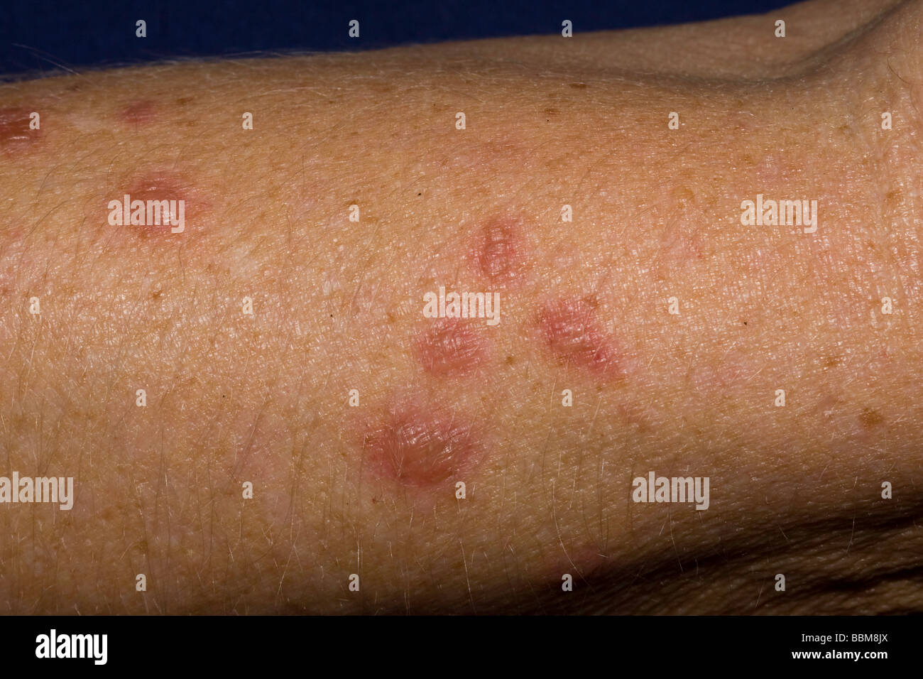Traitement du cancer de la peau pour les kératoses actiniques solaires/sont pré- lésions cancéreuses et peuvent être traités par la congélation à l'azote liquide Banque D'Images