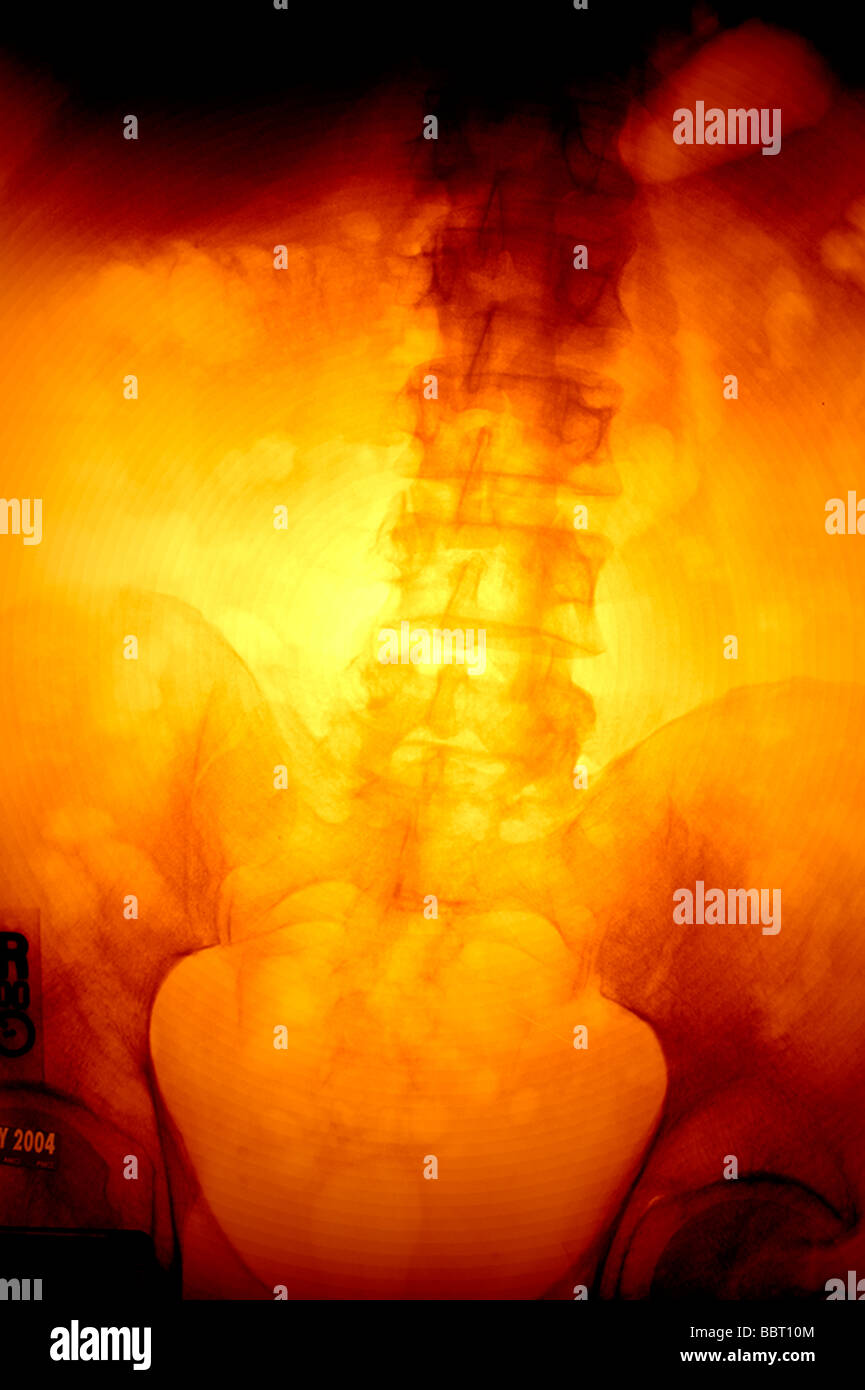 Des codes de couleur x-ray de la colonne vertébrale Banque D'Images