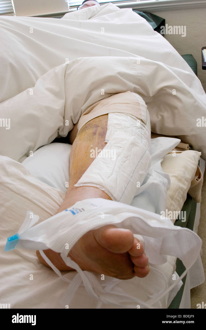 Photos post-opératoire d'un patient après un accident de vélo de montagne de médecins requis une vis plaque de titane dans la jambe gauche Banque D'Images