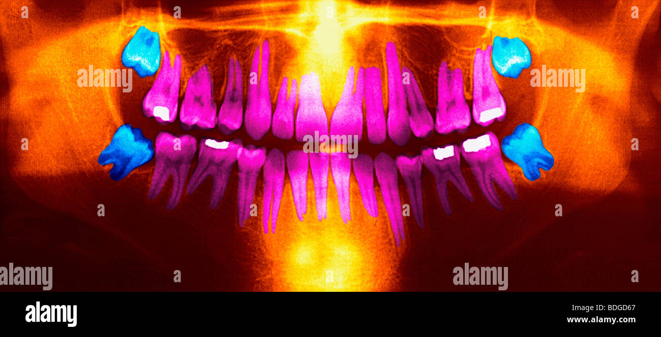 Dent de sagesse, X RAY Banque D'Images