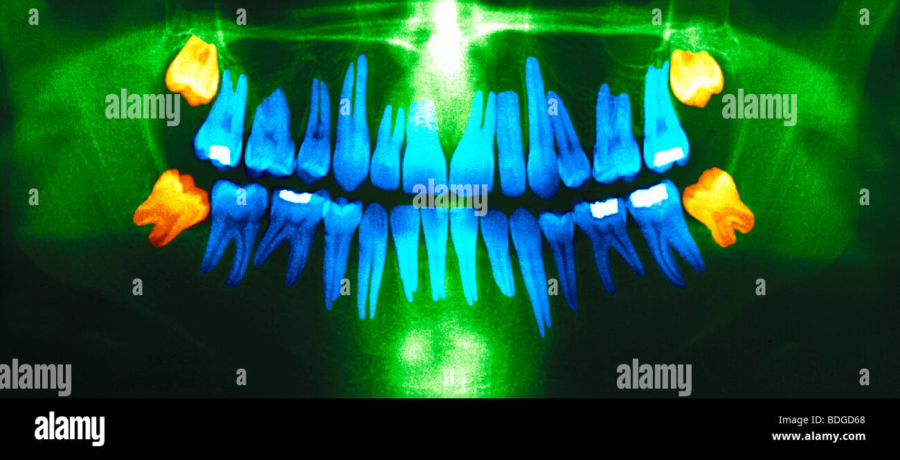 Dent de sagesse, X RAY Banque D'Images