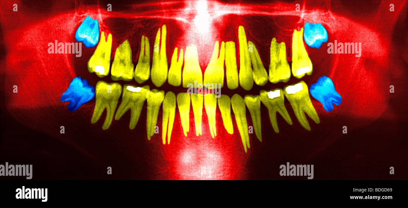 Dent de sagesse, X RAY Banque D'Images