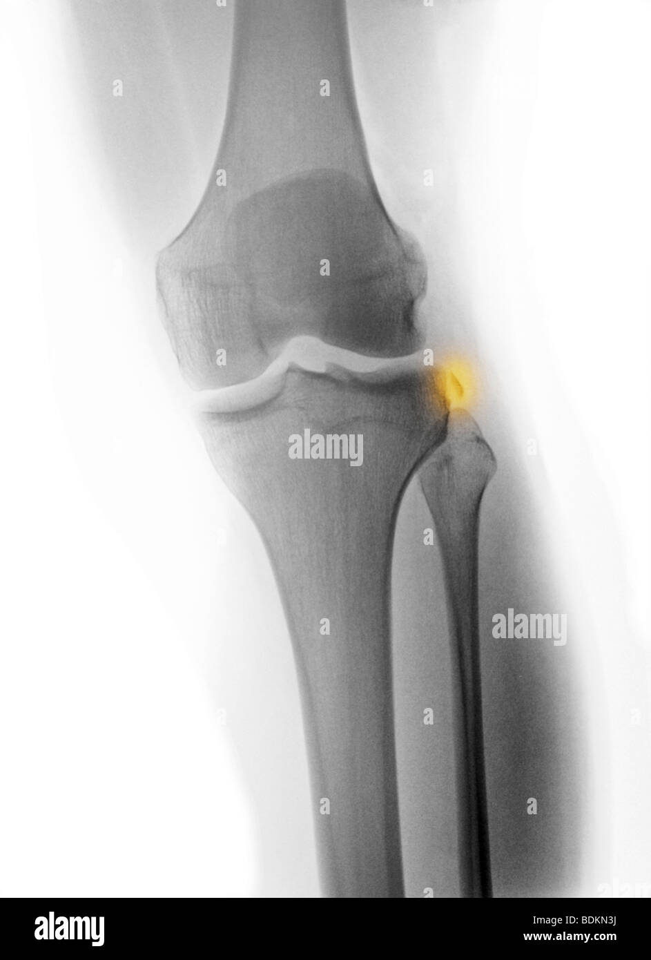 X-ray du genou d'un jeune de 18 ans l'homme avec une fracture-avulsion de la face latérale du genou causée par une déchirure du ligament Banque D'Images