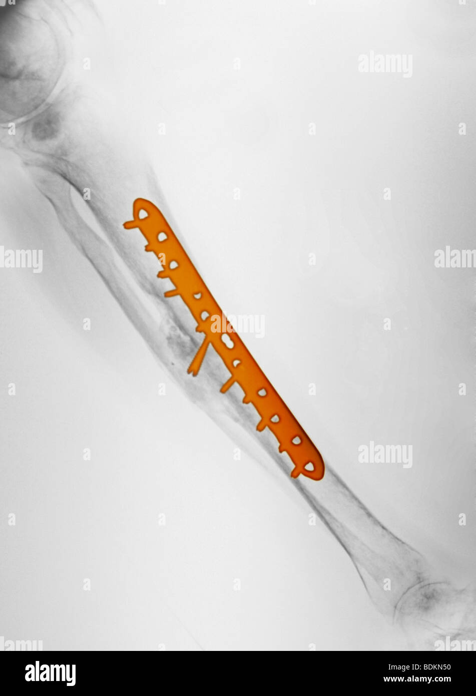 X-ray montrant la réparation chirurgicale du tibia et du péroné d'un vieil homme de 58 ans impliqué dans un accident de moto Banque D'Images