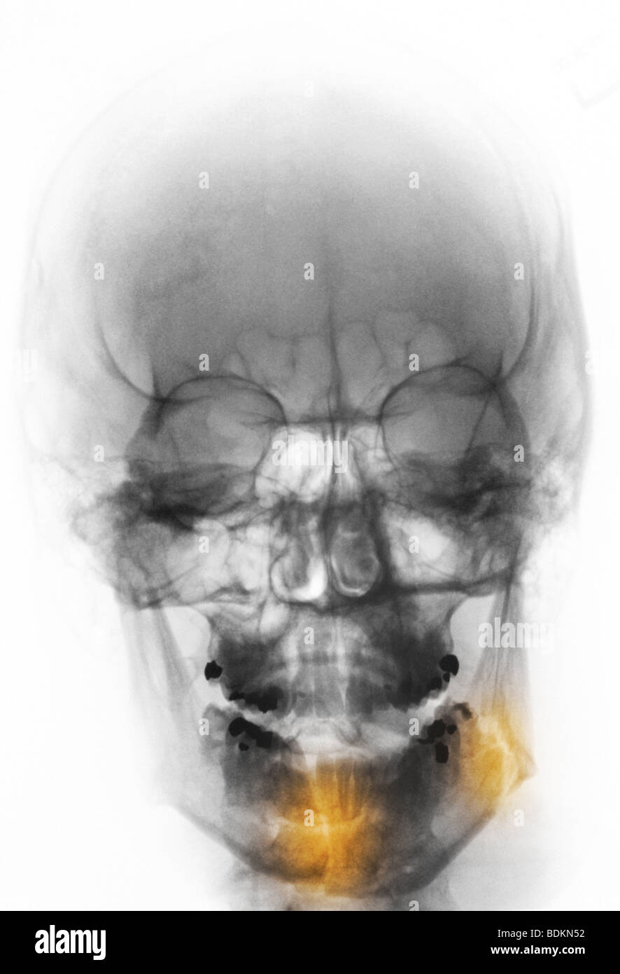 X-ray du crâne d'un homme de 28 ans qui a été frappé au visage. Il y a deux fractures de la mâchoire inférieure (mandibule) Banque D'Images