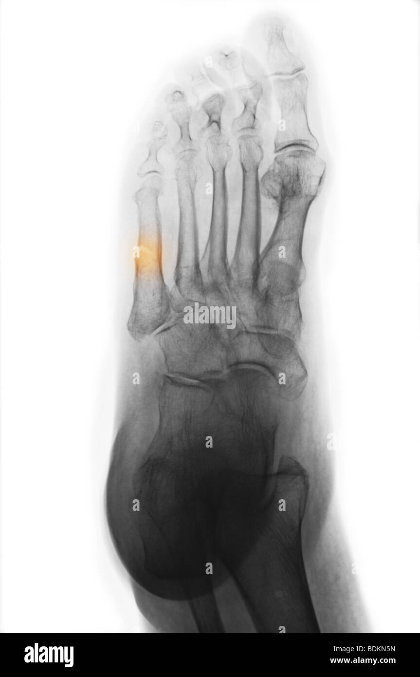 Pied x-ray of a 74 ans, femme, et montrant une fracture du 5e métatarse Banque D'Images