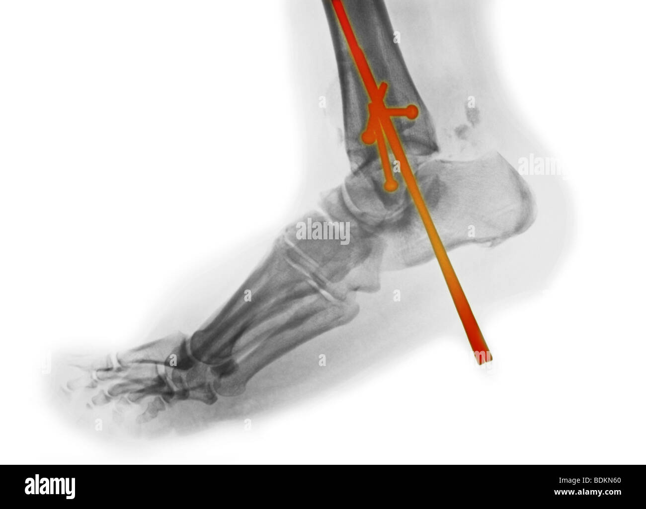 X-ray du pied d'une femme de 61 ans avec une fracture comminutive de la cheville qui a été chirurgicalement réparée Banque D'Images