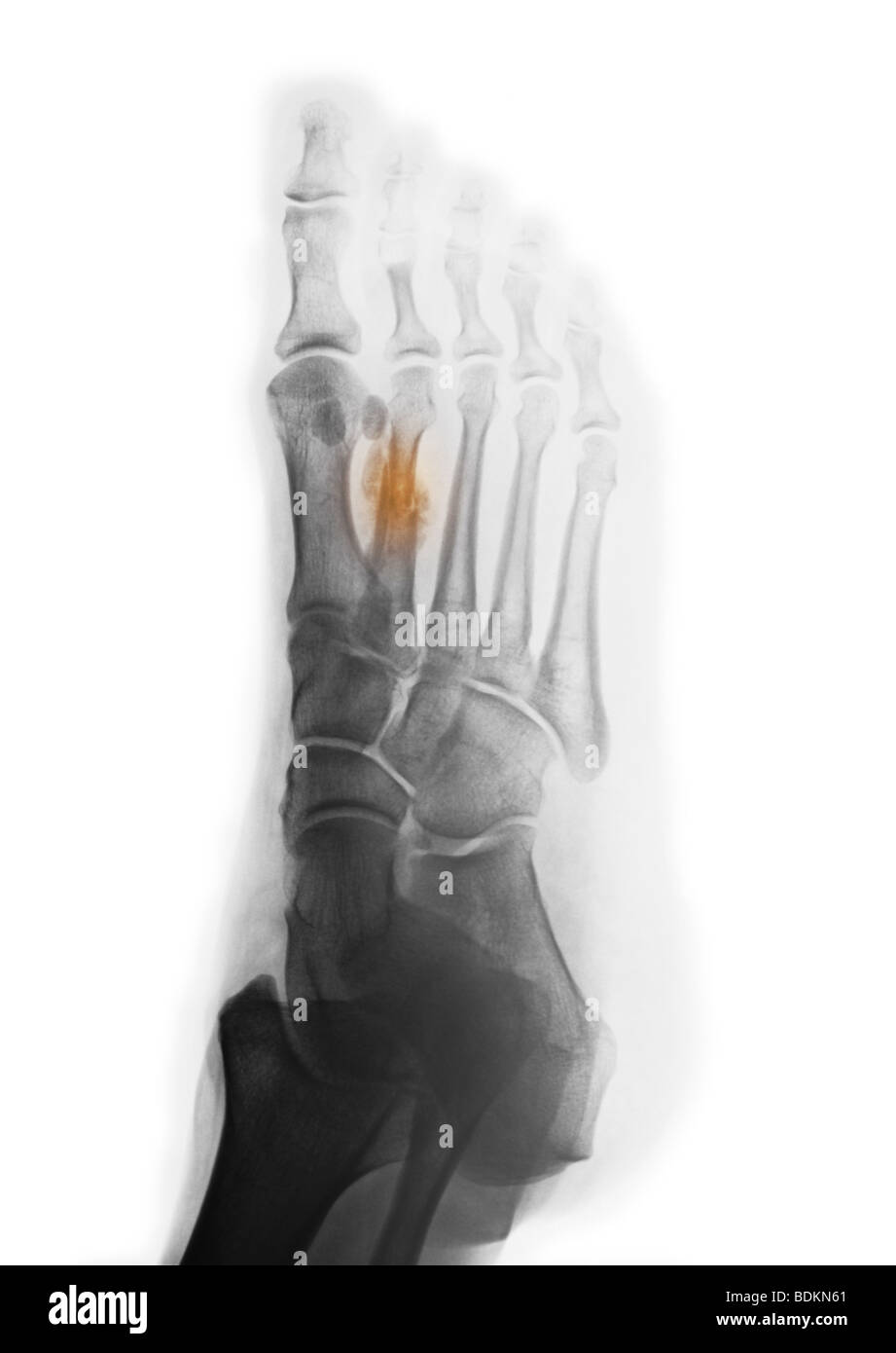 X-ray du pied d'une femme de 44 ans montrant une fracture de guérison ...