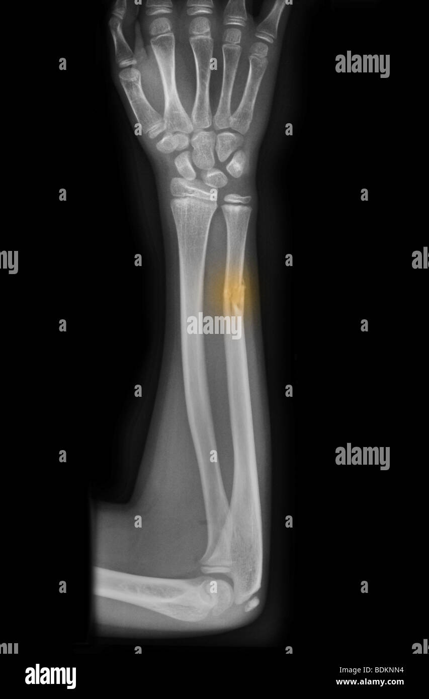 X-ray de l'avant-bras montrant une fracture du cubitus dans un garçon de 10 ans avec l'ostéogenèse imparfaite Banque D'Images