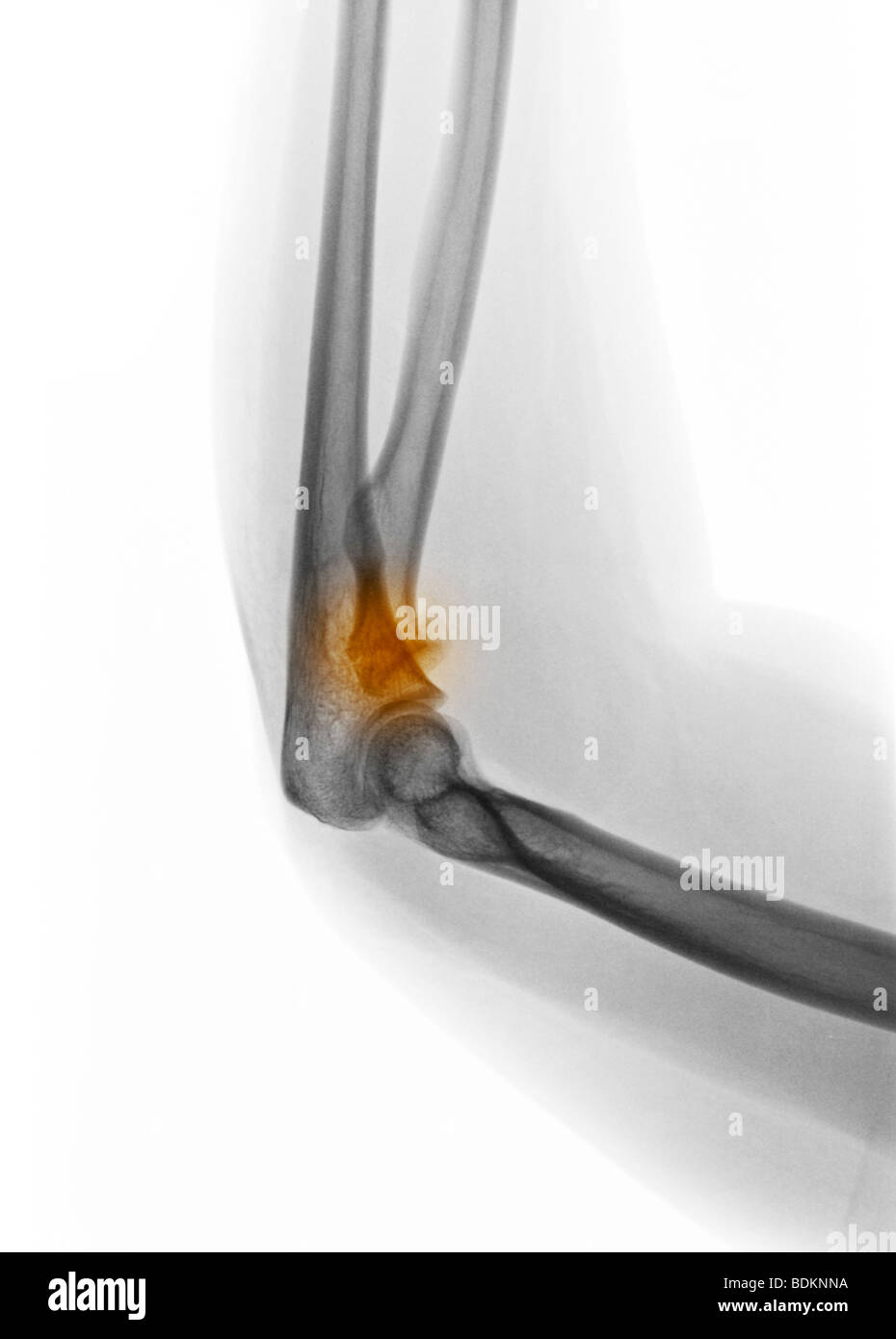 X-ray du coude montrant une fracture de la tête radiale dans 19 ans ...