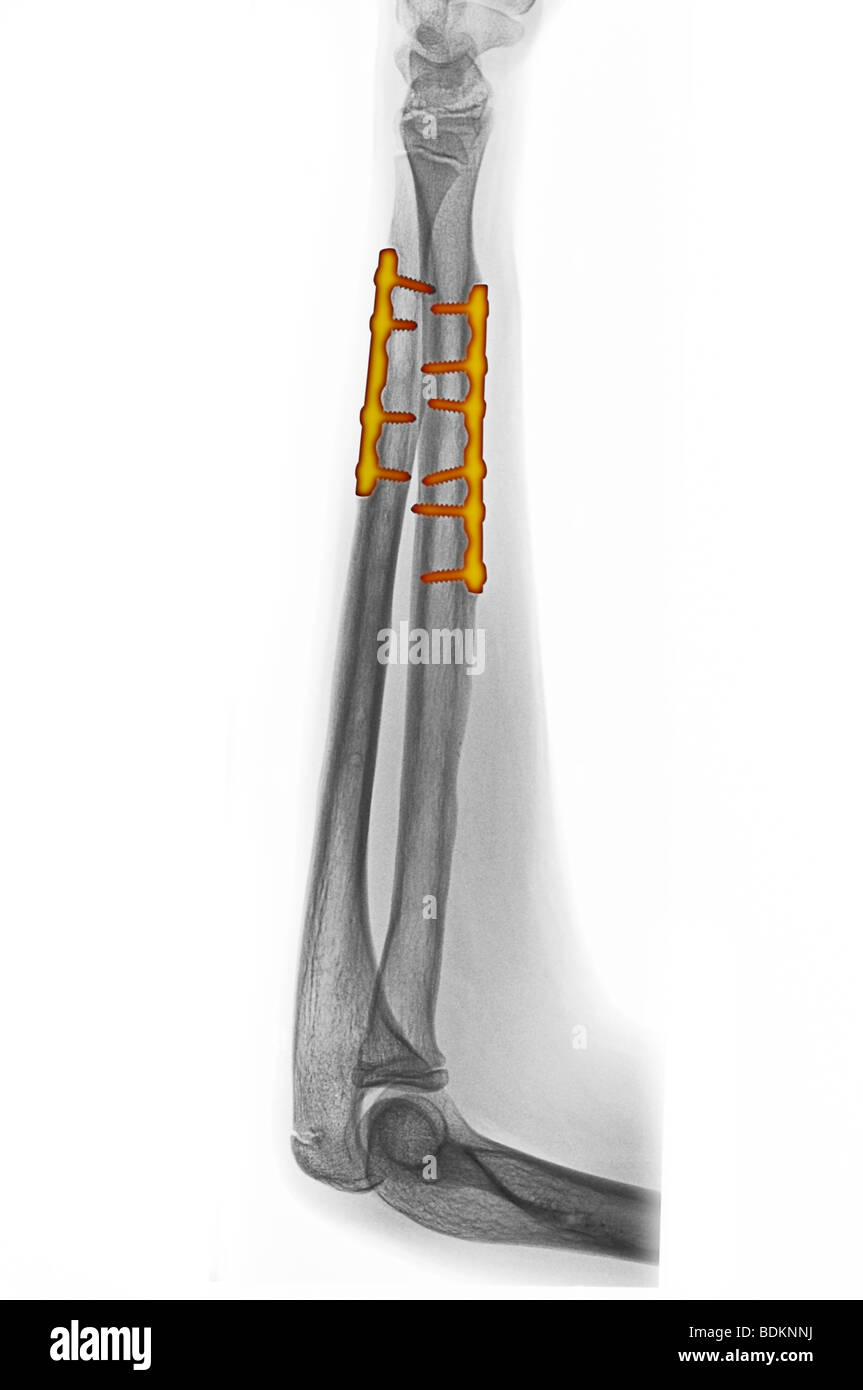 X-ray de l'avant-bras d'un garçon de 14 ans montrant des plaques de métal et des vis utilisées pour réparer sa fracture radius et cubitus Banque D'Images