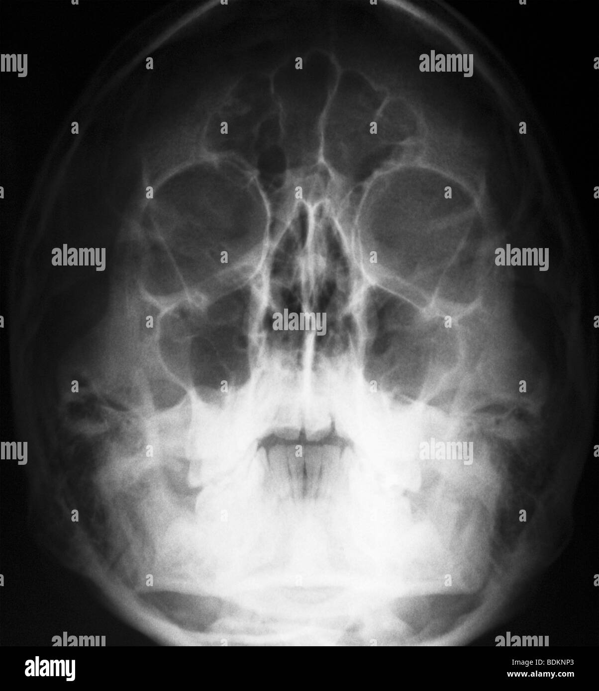 Skull x-ray de âgé de 17 ans Banque D'Images Skull x-ray de âgé de 17 ans Banque D'Images