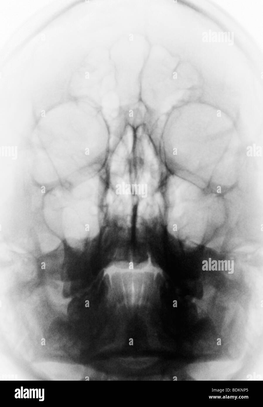 Skull x-ray de âgé de 17 ans Banque D'Images Skull x-ray de âgé de 17 ans Banque D'Images