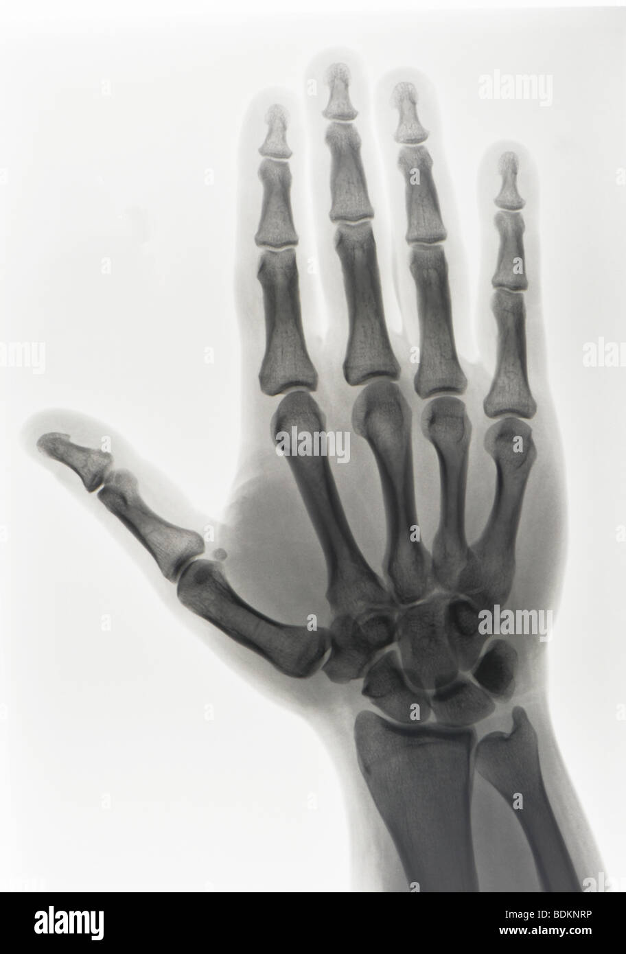 X-ray de la main d'un homme de 36 ans, normal Banque D'Images