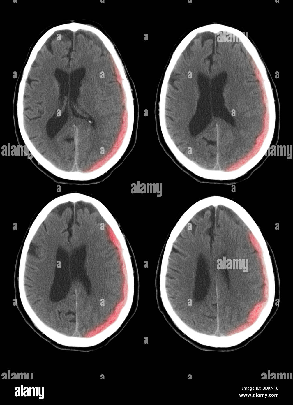Scanographie du cerveau d'un homme de 73 ans montrent une hémorragie intracrânienne Banque D'Images