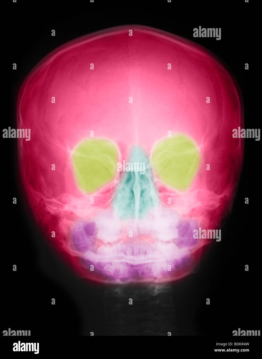 Crâne normal radiographie d'un garçon de 8 ans Banque D'Images Crâne normal radiographie d'un garçon de 8 ans Banque D'Images