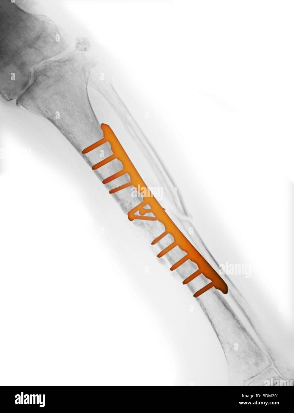 X-ray montrant la réparation chirurgicale du tibia et du péroné d'un vieil homme de 58 ans impliqué dans un accident de moto Banque D'Images
