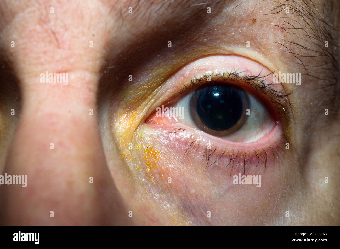 Patient de pupille dilatée après examen ophtalmologique à New York Banque D'Images