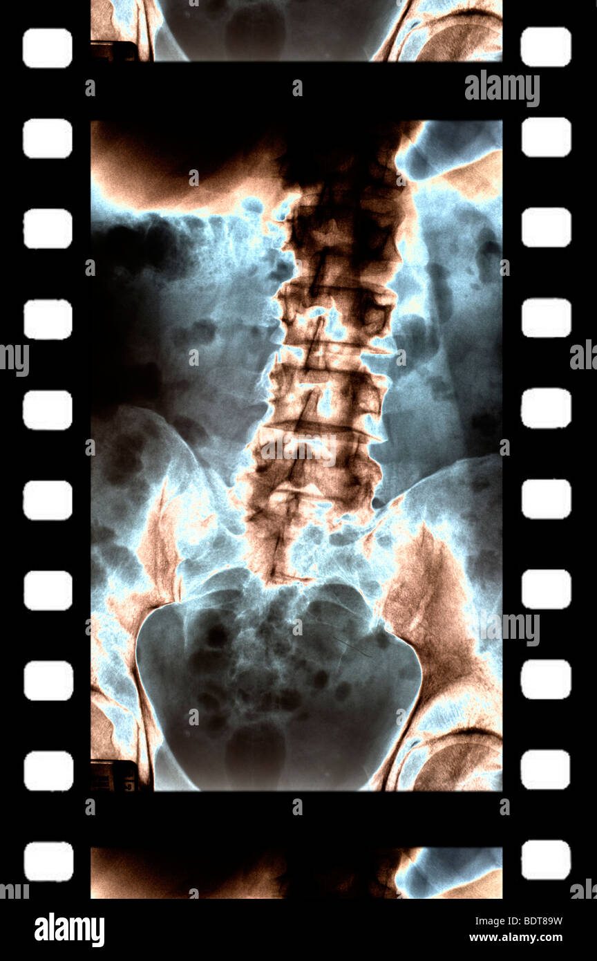 Des codes de couleur x-ray de la colonne vertébrale sur vue du film Banque D'Images