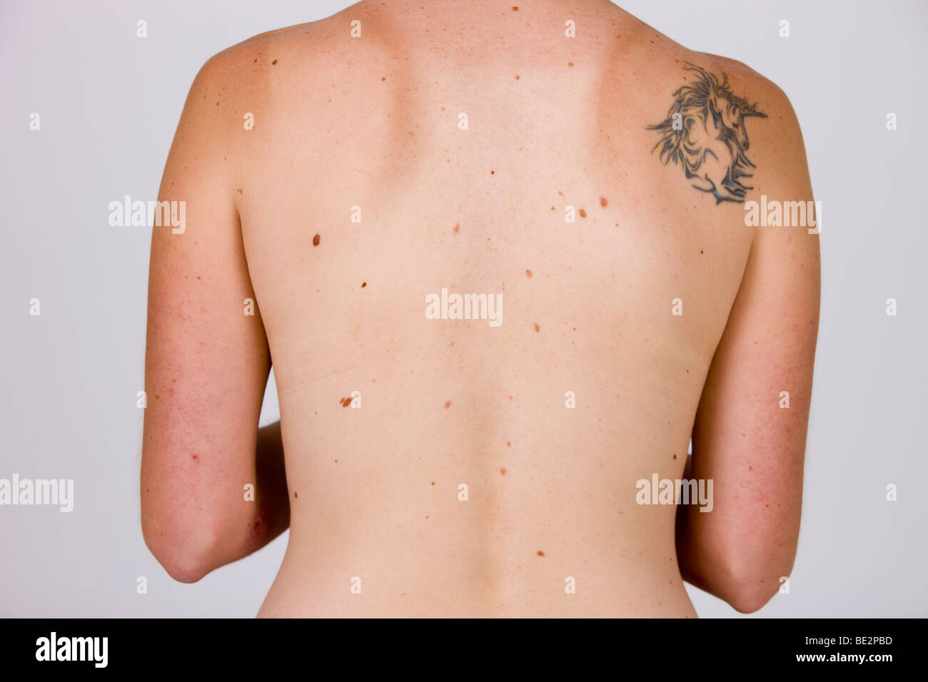 Beauté sur le dos, le risque de cancer de la peau Banque D'Images