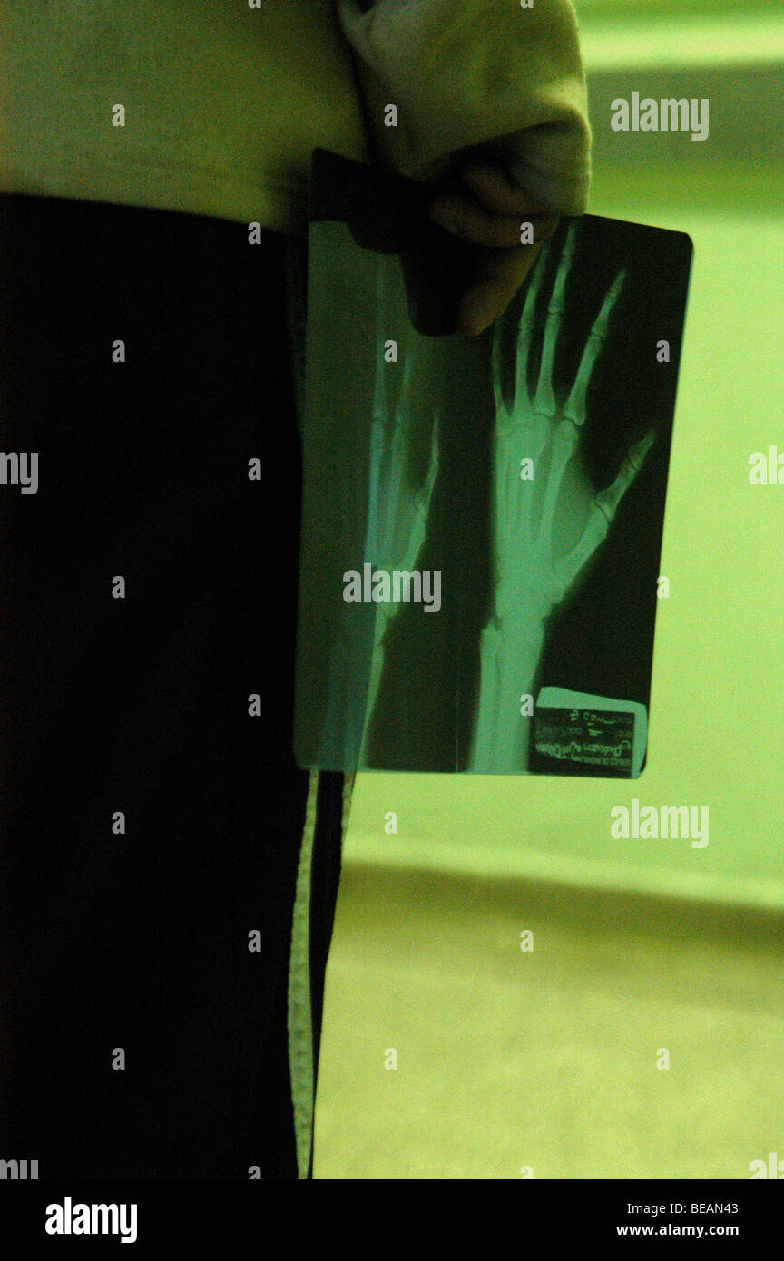 Un homme tenant une main de son X la radiographie. Votorantim, São Paulo, Brésil. 15/06/2009 à 10:32am. Banque D'Images