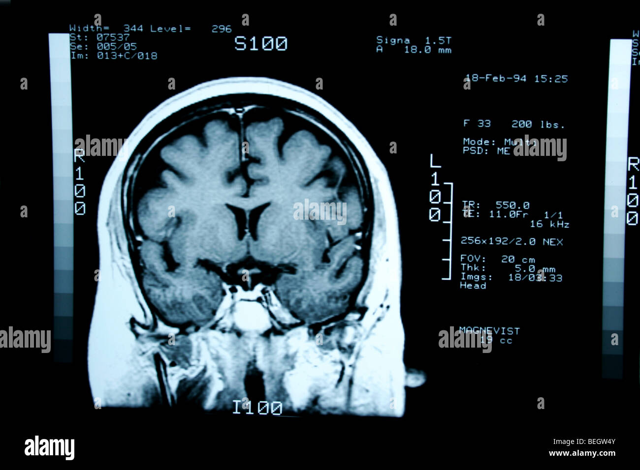 Irm du cerveau du patient avec et sans agent de contraste Banque D'Images