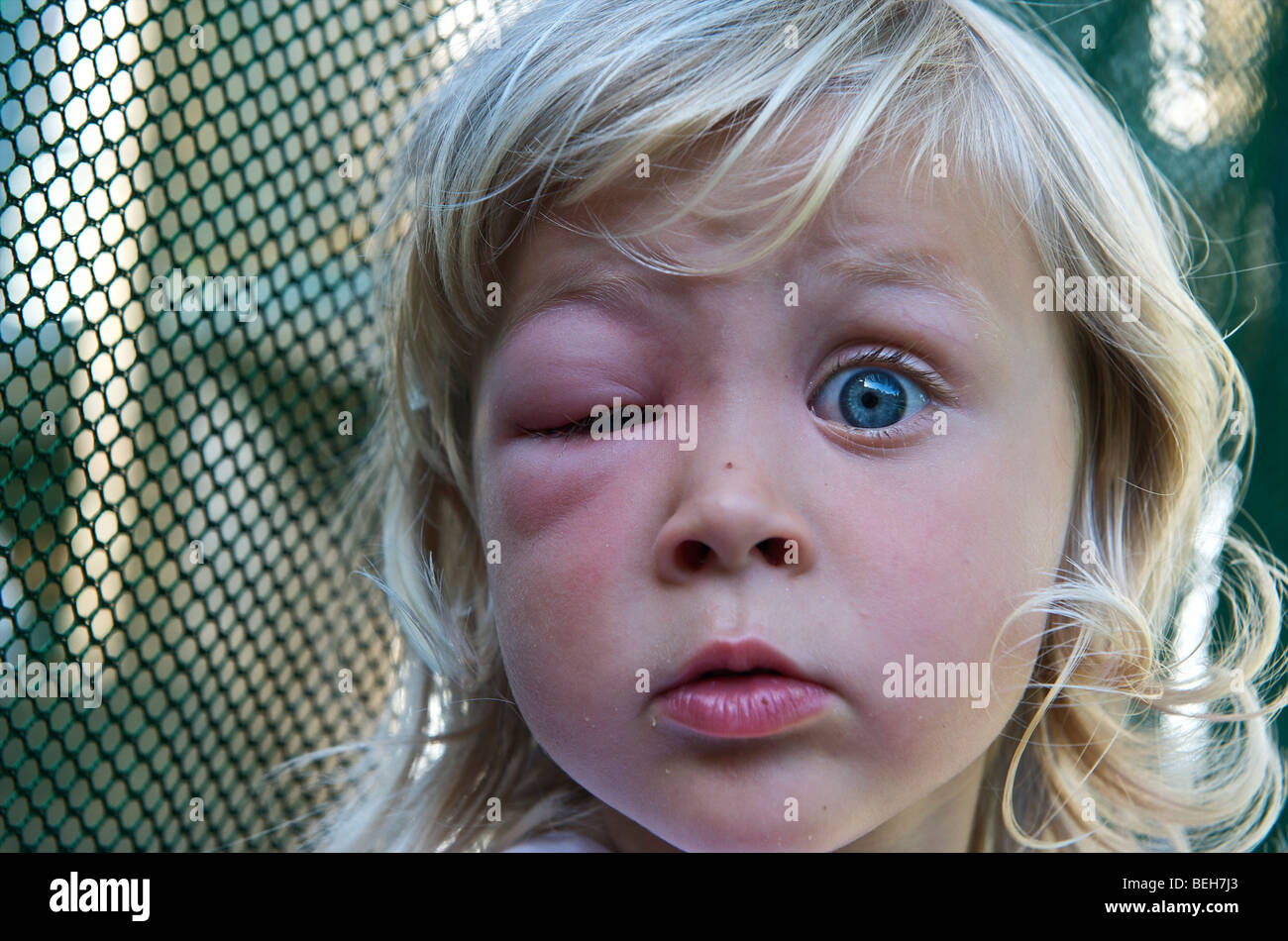 4 ans, fille, avec un œil enflé d'une piqûre de guêpe Banque D'Images