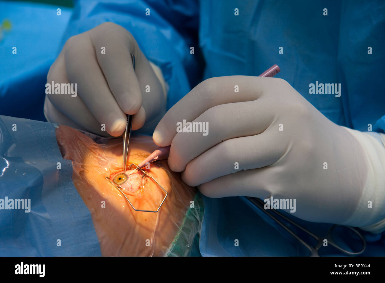 Opération des yeux - lens implantation Banque D'Images