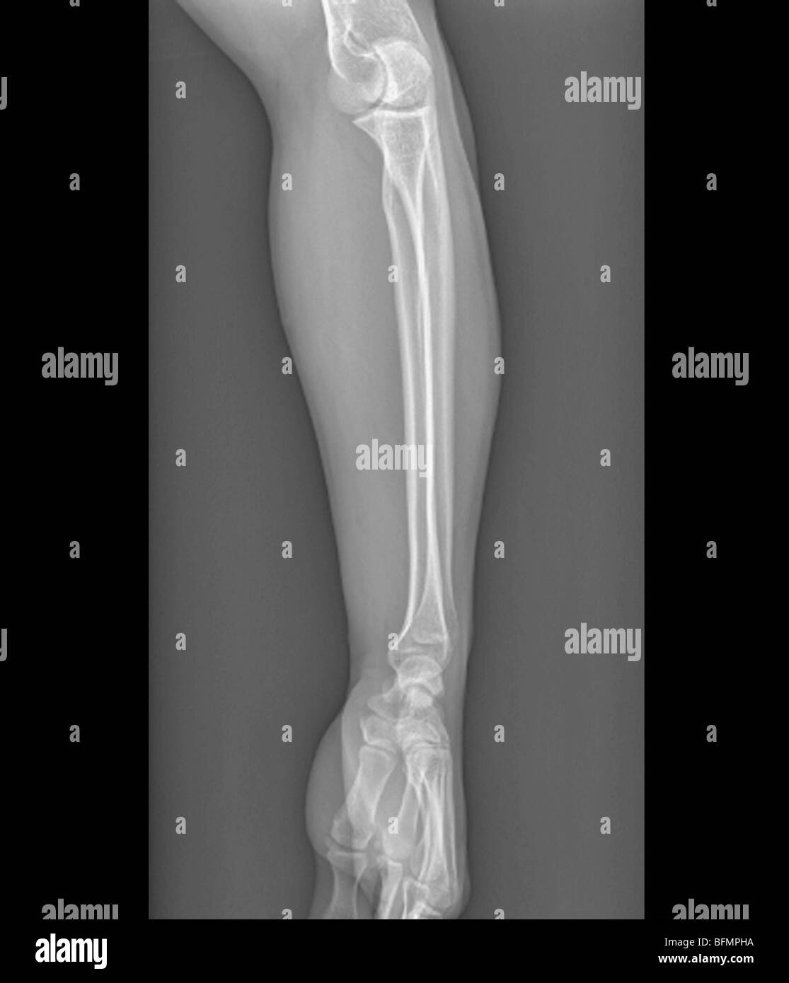 Les articulations du coude et du poignet normal, X-ray Banque D'Images