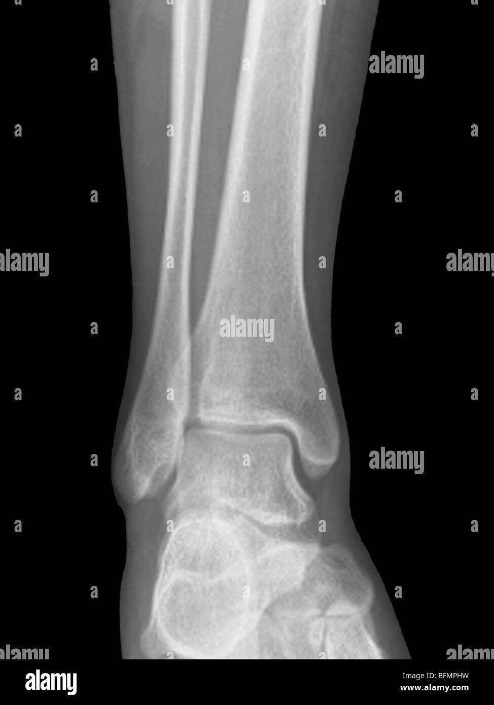 La normale de la cheville, X-ray Photo Stock - Alamy