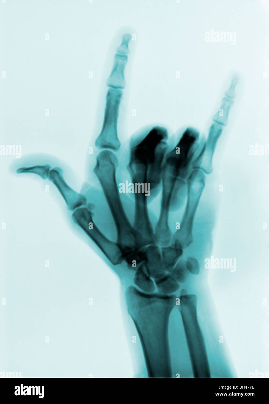 X-ray shoing la langue des signes pour "I love you" Banque D'Images