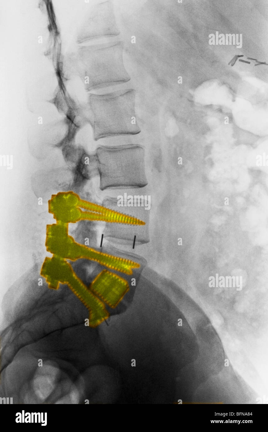X-ray montrant l'arthrodèse lombaire inférieure surgery Banque D'Images