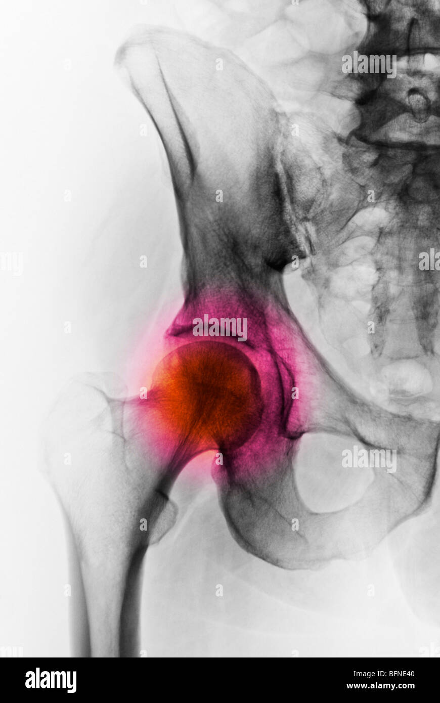 X-ray colorisée d'une hanche normale Banque D'Images