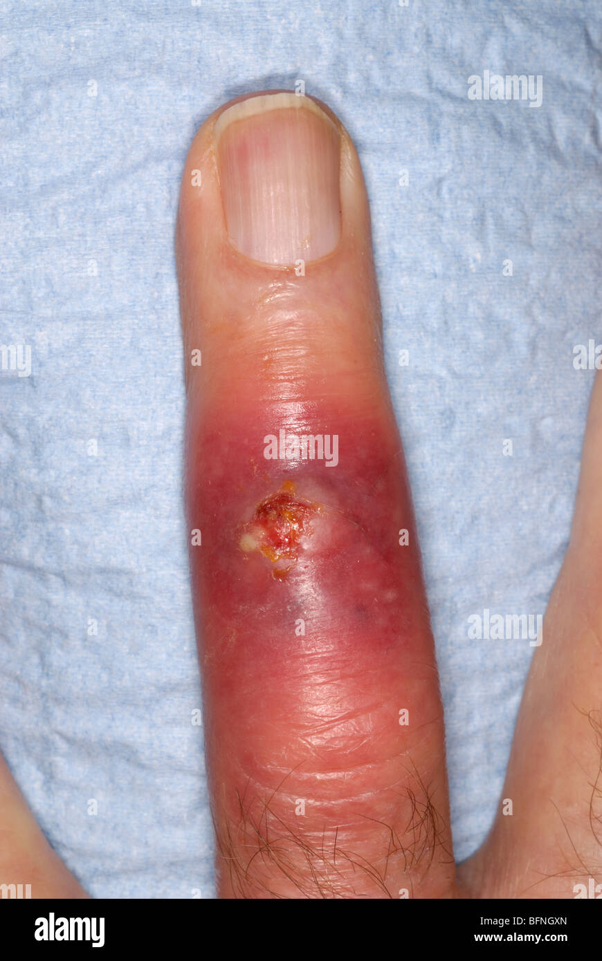 Le SARM infection staphylococcique sur l'anneau de doigt d'un homme de 79 ans ayant des antécédents de diabète Banque D'Images
