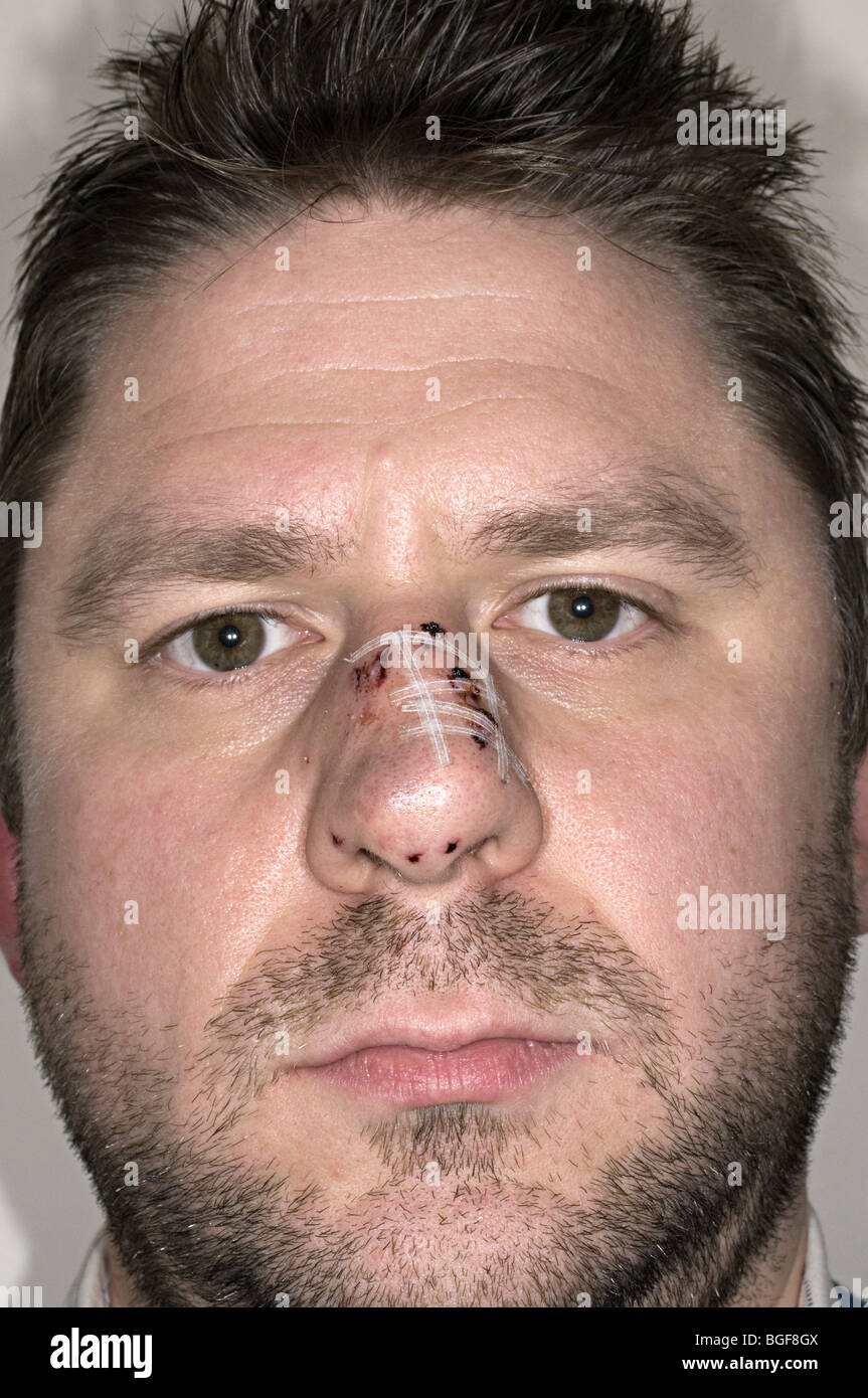 Homme avec steri strips sur son nez après une morsure de chien sur le nez Banque D'Images