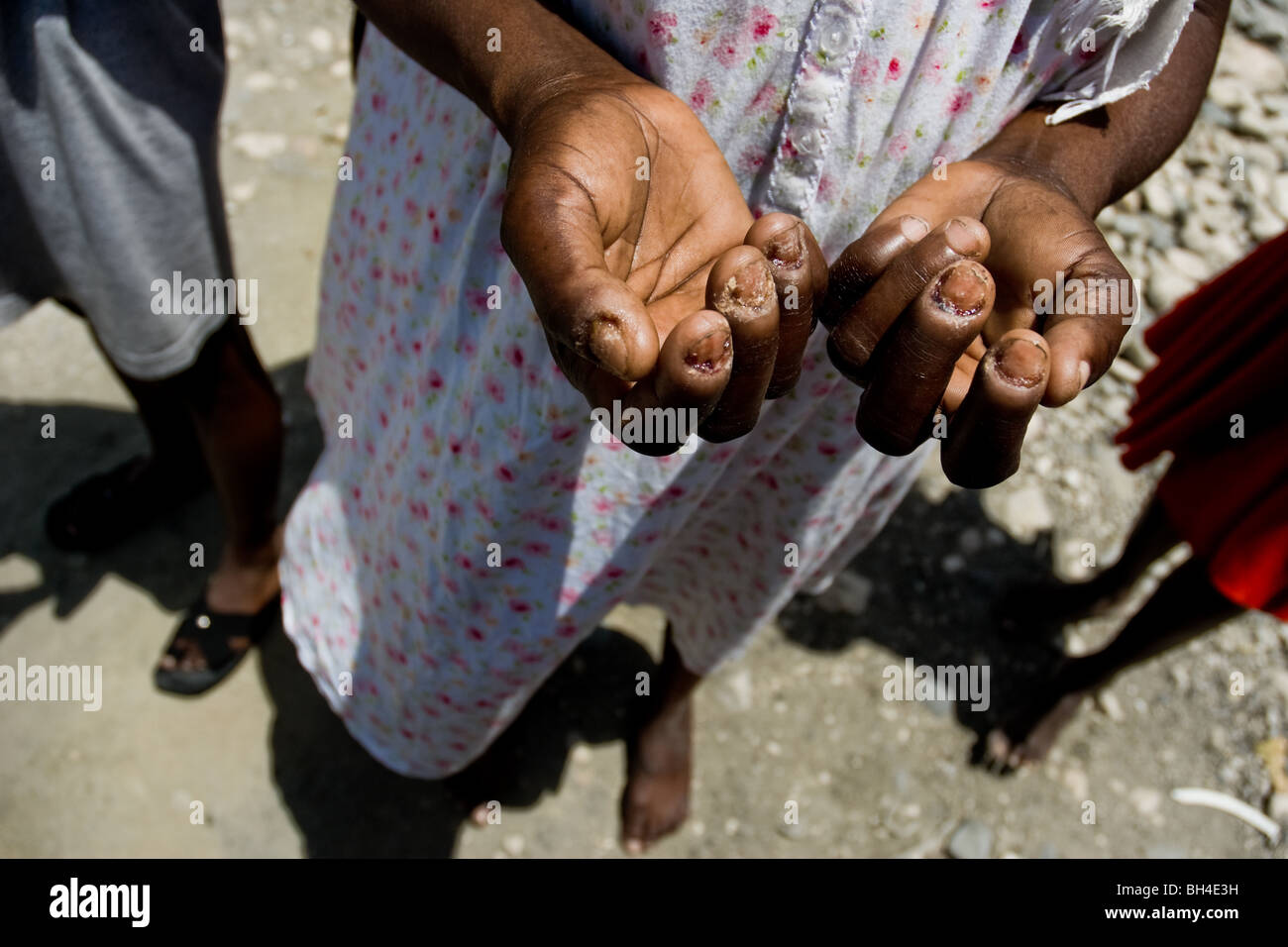 Une femme haïtienne montrant une maladie de peau et ongles la déformation  dans le bidonville de Cité Soleil Photo Stock - Alamy