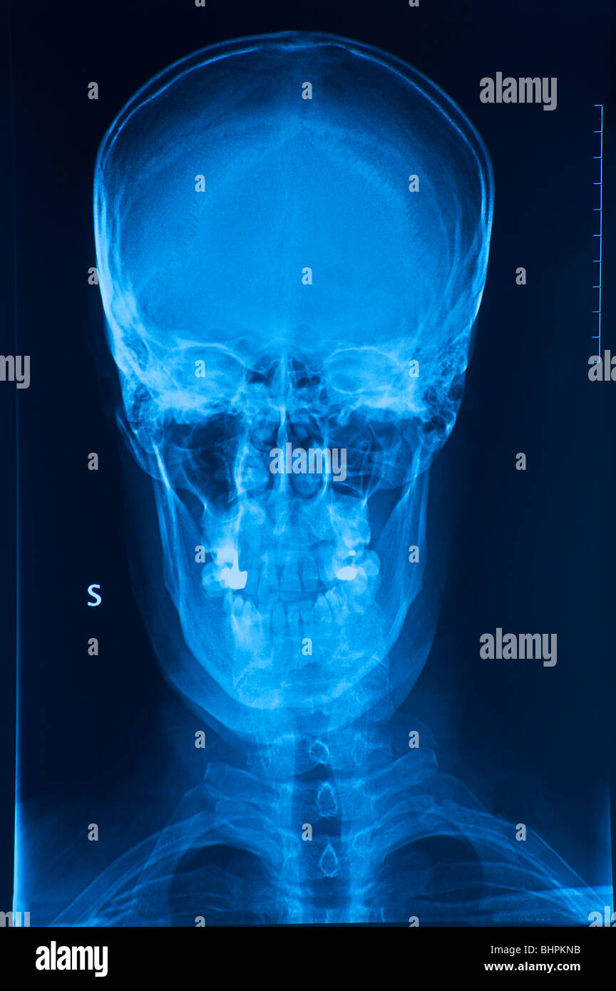 Crâne avant x-ray image Banque D'Images