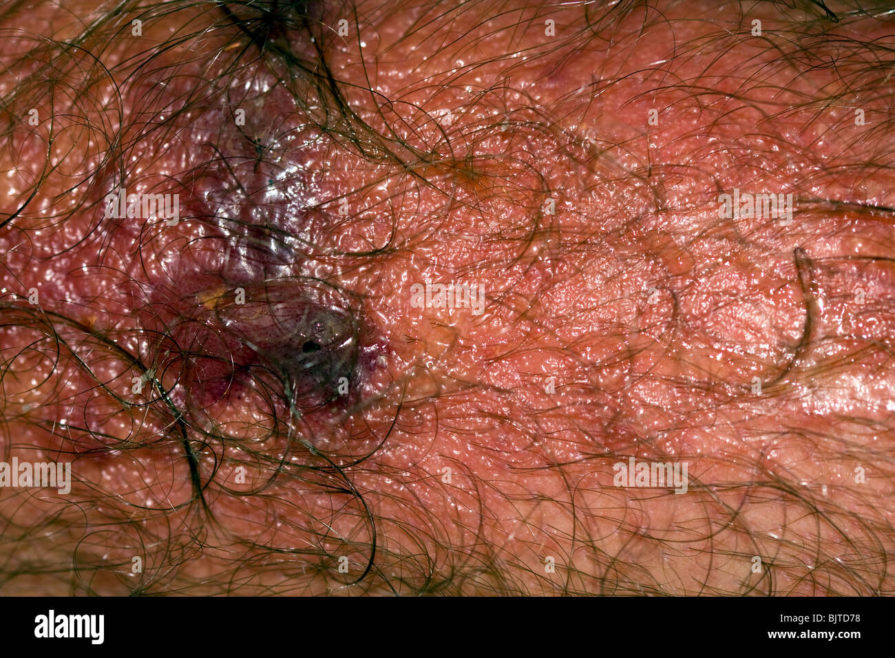 what does poison ivy rash look like what does poison ivy rash look like