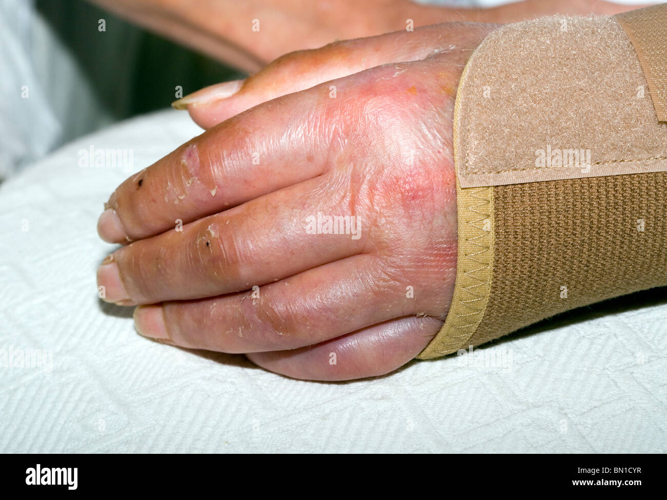Les blessures de la main et du poignet après dépose de plâtre à six semaines,, Londres, Angleterre, Royaume-Uni, Europe Banque D'Images