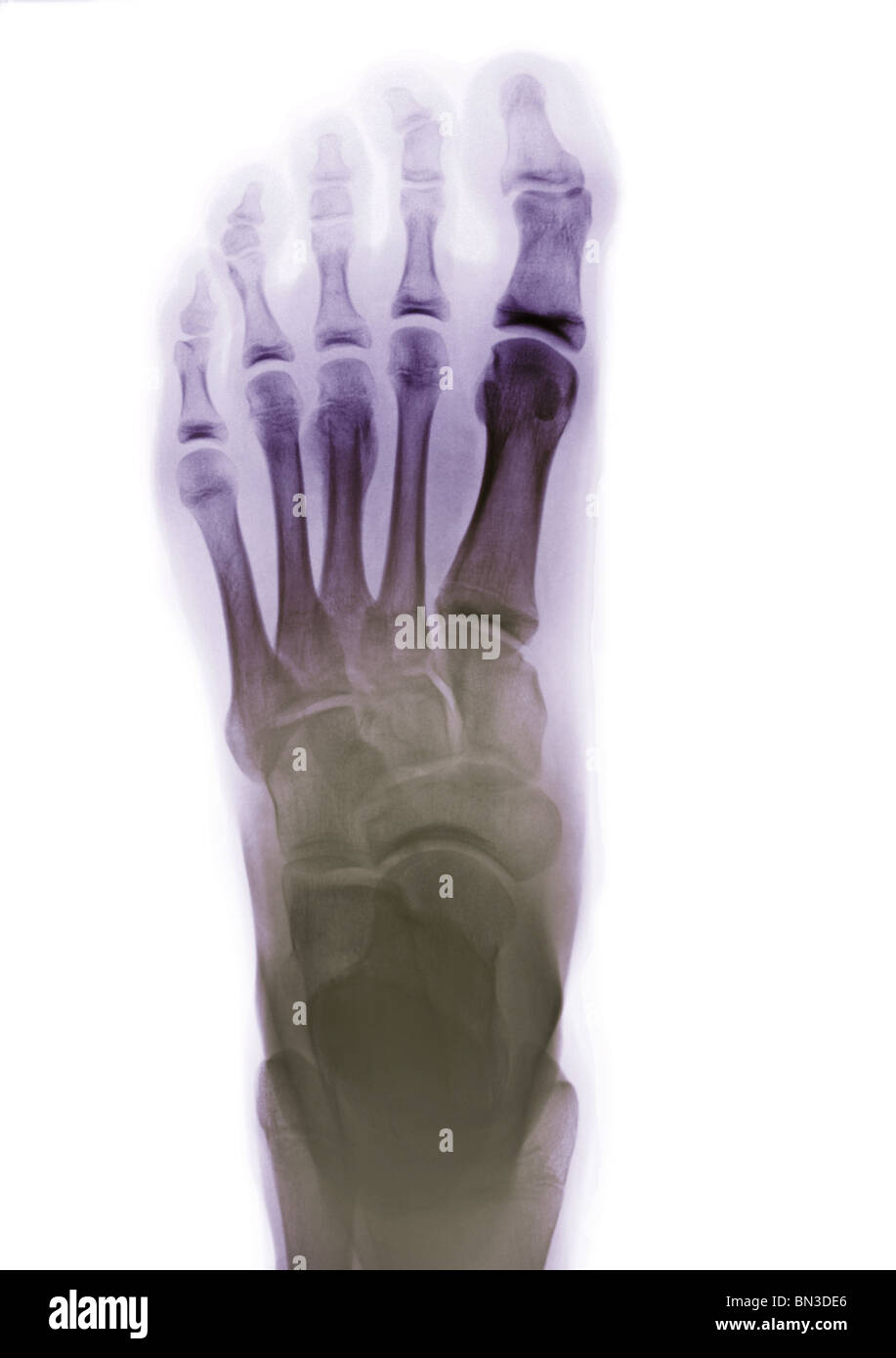 Colorisées, radiographie d'un pied humain Banque D'Images
