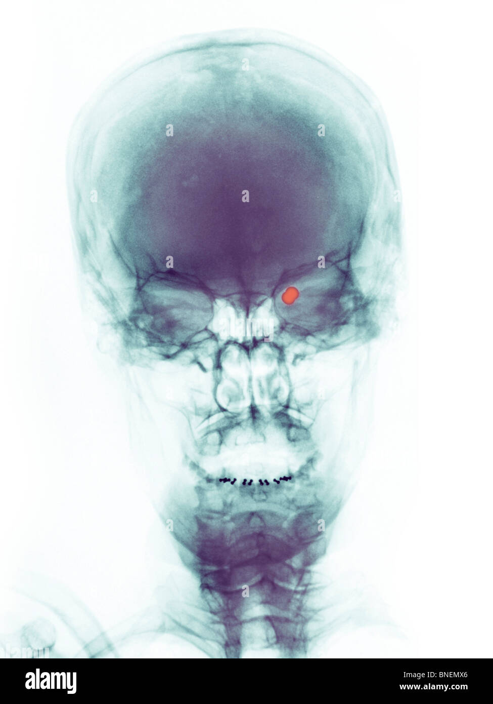 Rayons x du crâne d'une femme d'une balle dans l'oeil avec une arme à plombs. Banque D'Images