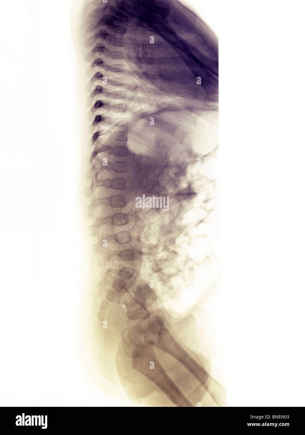 X-ray de la colonne vertébrale d'une fillette de 3 mois Banque D'Images X-ray de la colonne vertébrale d'une fillette de 3 mois Banque D'Images