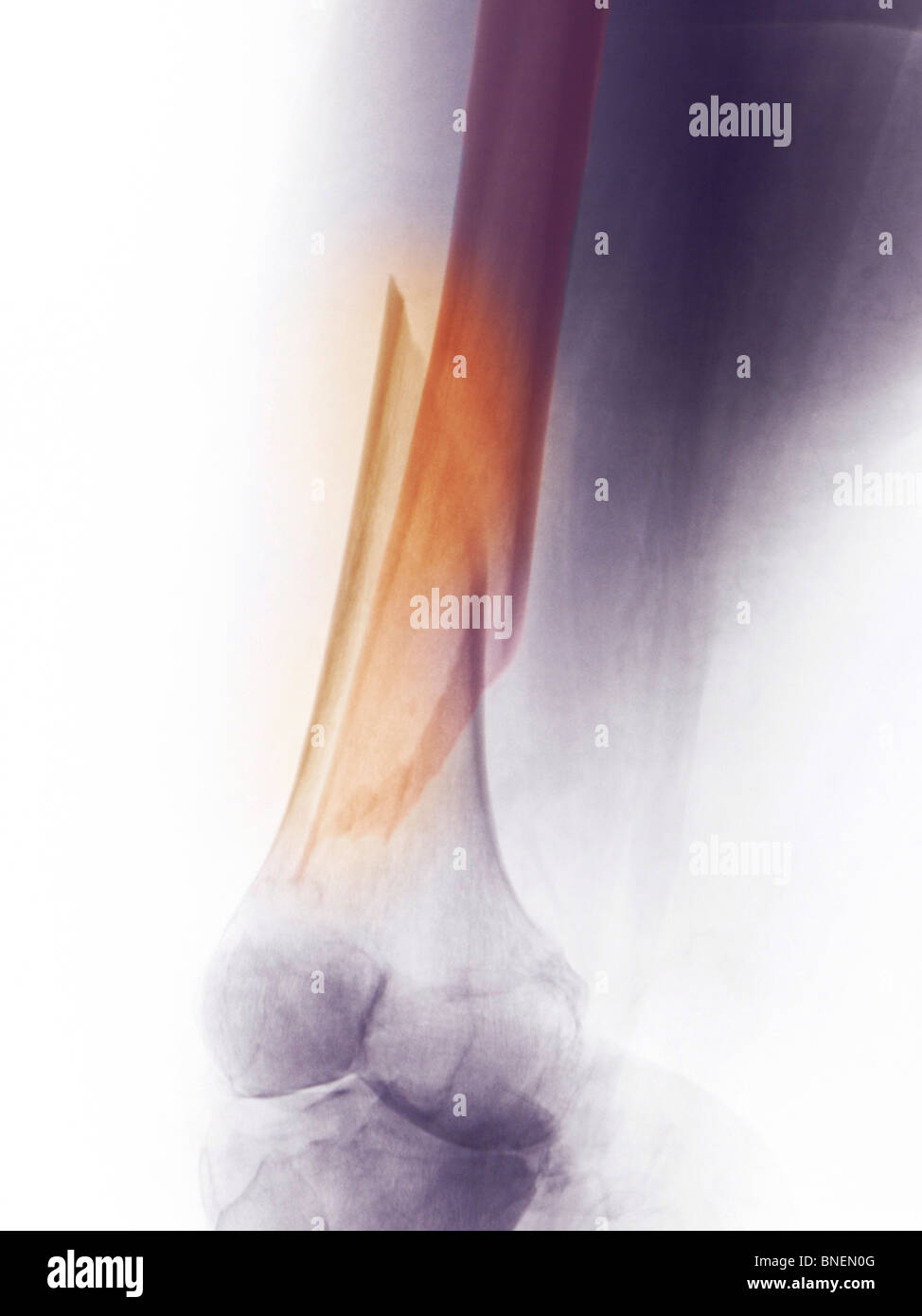 Radiographie d'une fracture du fémur distal Banque D'Images