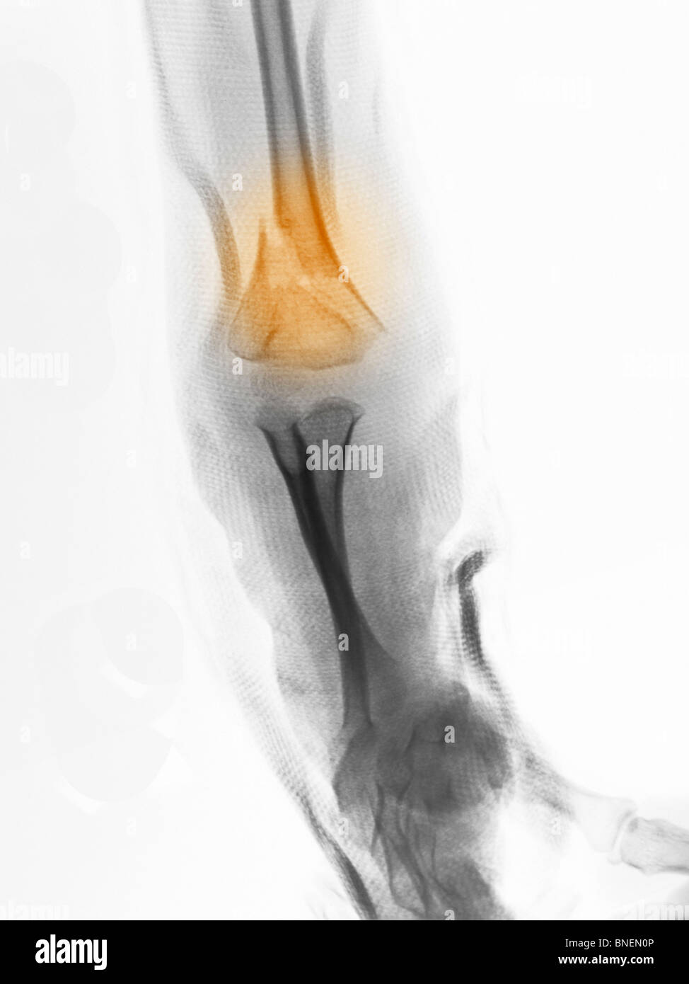 Radiographie d'une fracture de l'humérus distal Banque D'Images