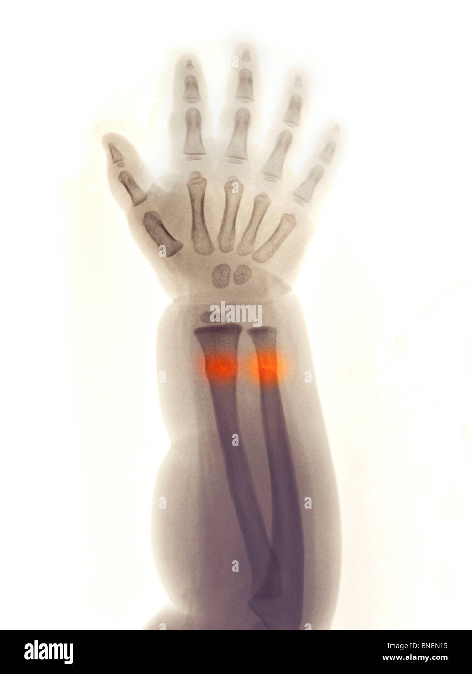 L'avant-bras et la main x-ray, greenstick Fracture du radius et cubitus distal. Banque D'Images